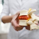 The doctor holds in his hands a model of a herniated lumbar disc of the spine